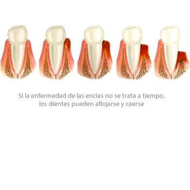 Periodontitis Periodontitis